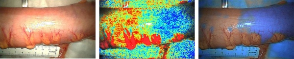 通常観察画像（左図）と、酸素飽和度イメージング技術で得られる画像（中央図・右図）