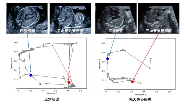胎児心臓超音波スクリーニング動画へのグラフチャート図の適用（出所：プレスリリース、以下同）