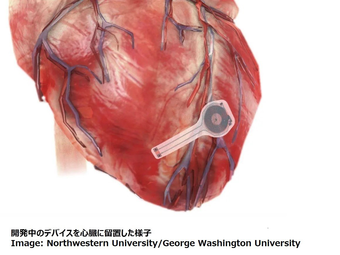 体内で分解するペースメーカーの開発へ一歩前進｜Beyond Health