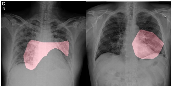 （写真2）COVID-Net を活用するツール「GSInquire」によって特定された、2人の異なる患者の新型コロナウイルス感染症例の胸部X線撮影画像例。関連する重要な要素を赤で強調してある（GitHubのホームページより引用）